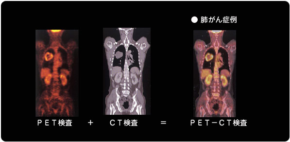 �x����Ǘ�iPET�����{CT������PET-CT�����j