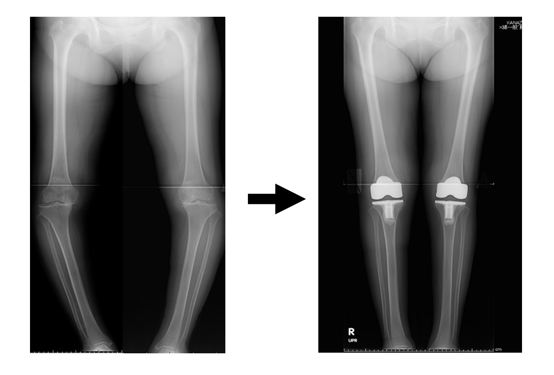 人工膝関節全置換術画像.jpg