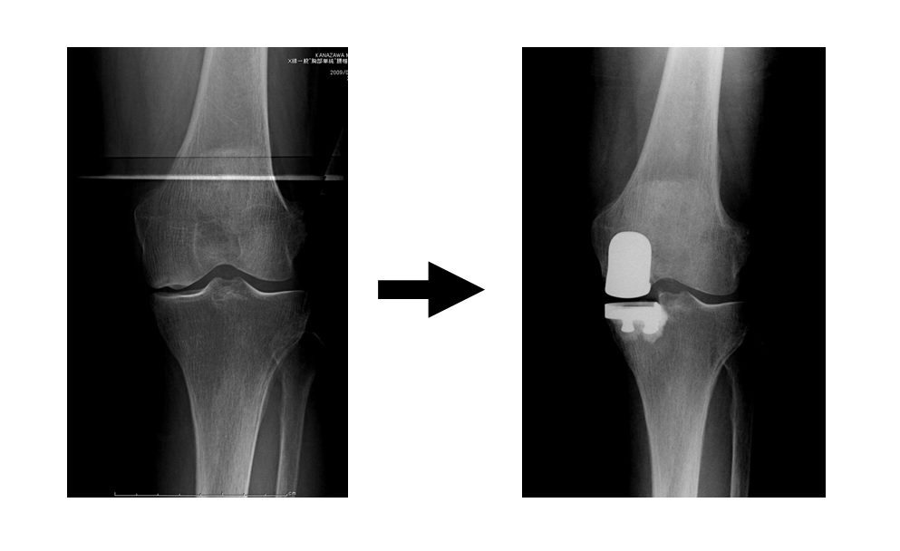 単顆型人工膝関節置換術画像.jpg