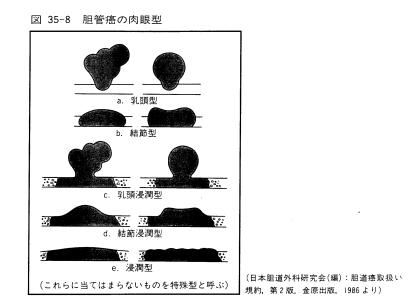 ポリープ 胆嚢