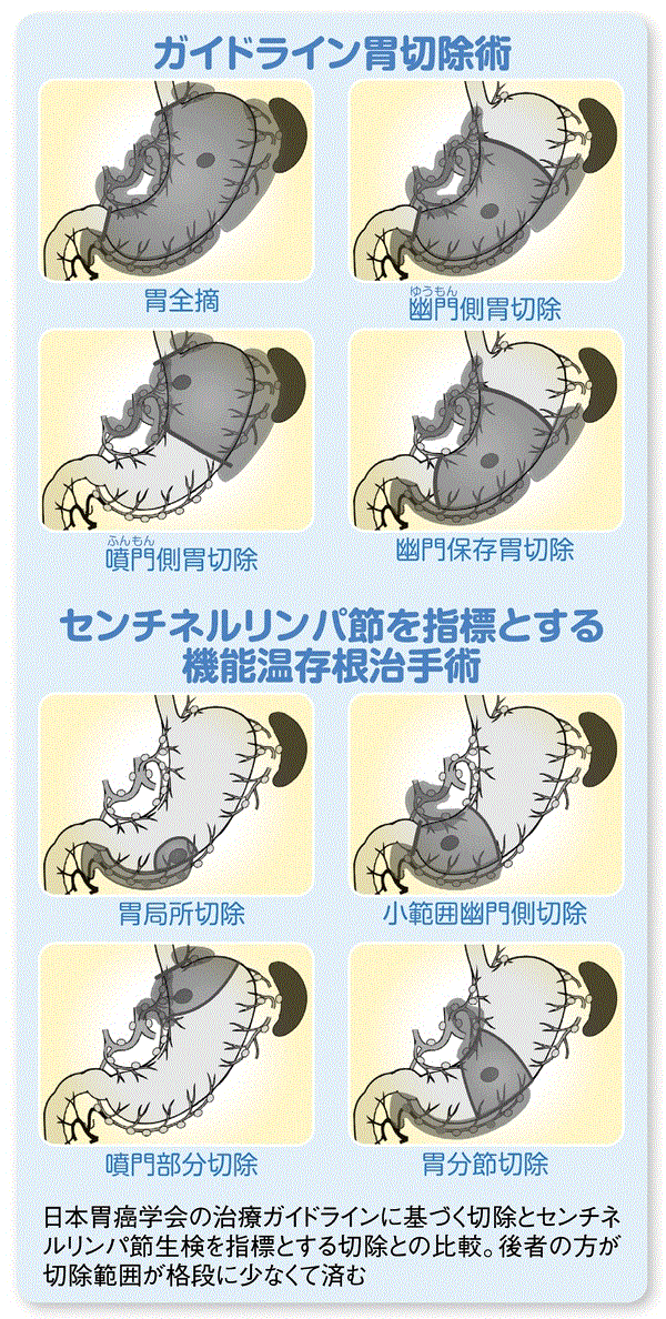 ガイドライン胃切除術.gif