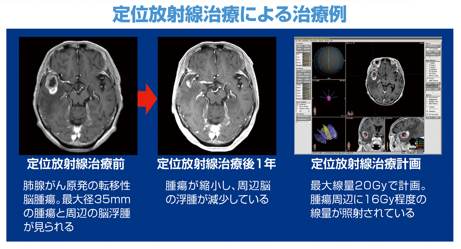 定位放射線治療.jpg