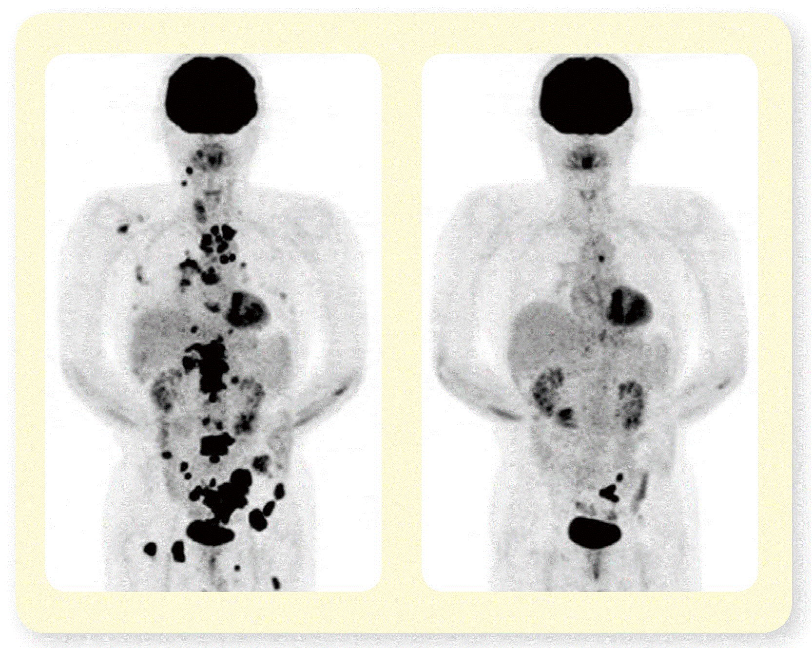 癌 肺に転移 余命 癌 肺に転移 余命