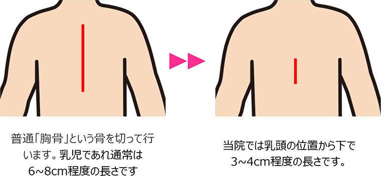 普通「胸骨」という骨を切って行います。乳児であれ通常は6~8cm程度の長さです。当院では乳頭の位置から下で3~4cm程度の長さです。