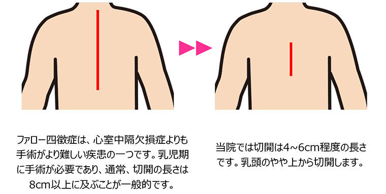 ファロー四徴症は、心室中隔欠損症よりも手術がより難しい疾患の一つです。乳児期に手術が必要であり、通常、切開の長さは8cm以上に及ぶことが一般的です。当院では切開は4~6cm程度の長さです。乳頭のやや上から切開します。