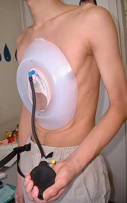 バキュームベル友の会｜金沢医科大学 小児外科学