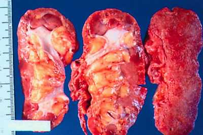 Atrophic Kidney