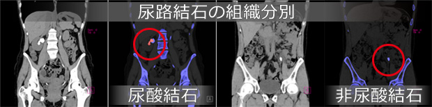 尿路結石の組織分別