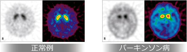 正常例　パーキンソン病