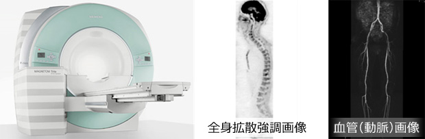 全身拡散強調画像　血管（動脈)画像