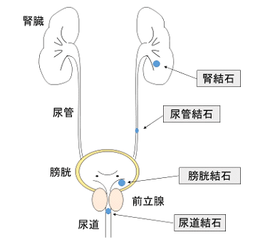 尿 路 結石 症状